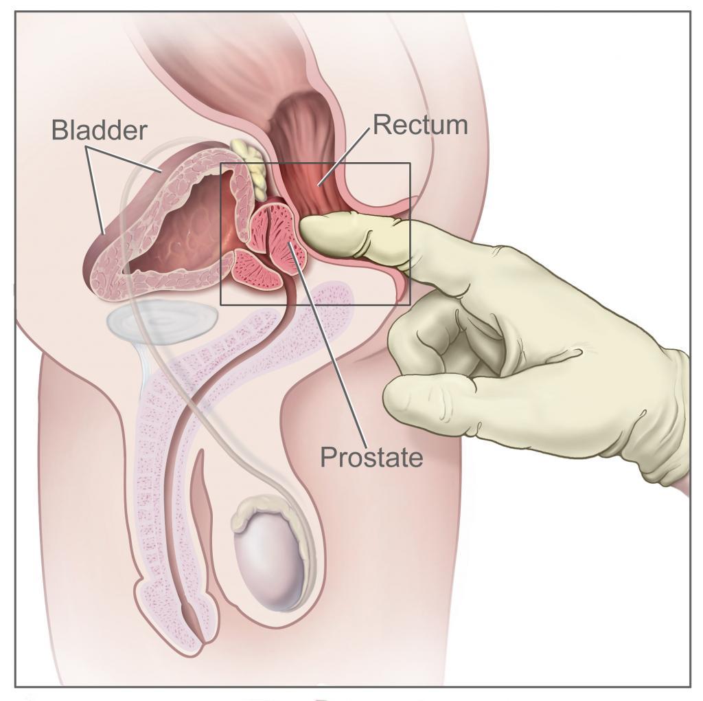 Rektale Untersuchung der Prostata DRU