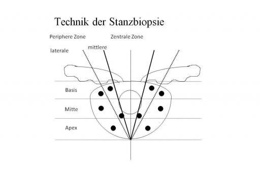 Technik der Stanzbiopsie, Regionen: APEX, MITTE, BASIS Lokalisation: laterale periphere, mittlere periphere und transitionale Zone 