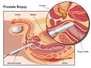 Prostata Biopsie, Gewebeentnahme