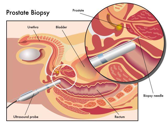 prostata biopsie wahrscheinlichkeit)