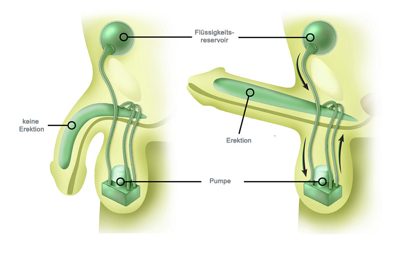 prostataentzündung erektionsprobleme vasiculita cu prostatita