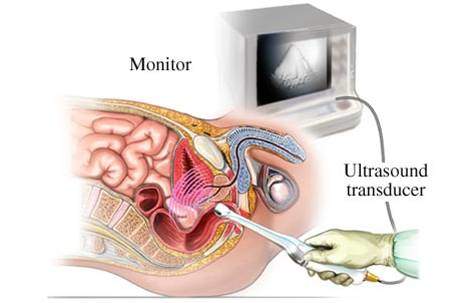 Ultraschall prostata