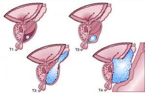 Klassifikation Prostatakrebs, TNM Klassifikation
